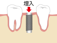 インプラント埋入